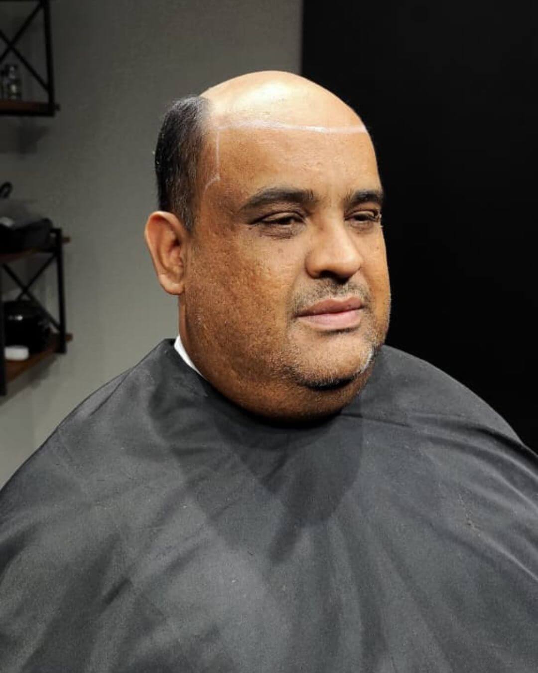 Antes - Prótese Capilar Ral Clinic